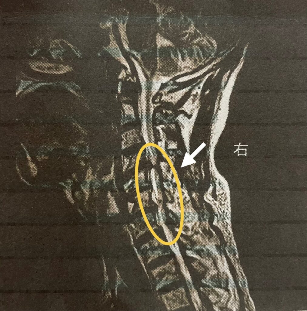 池渕さんのMRI画像