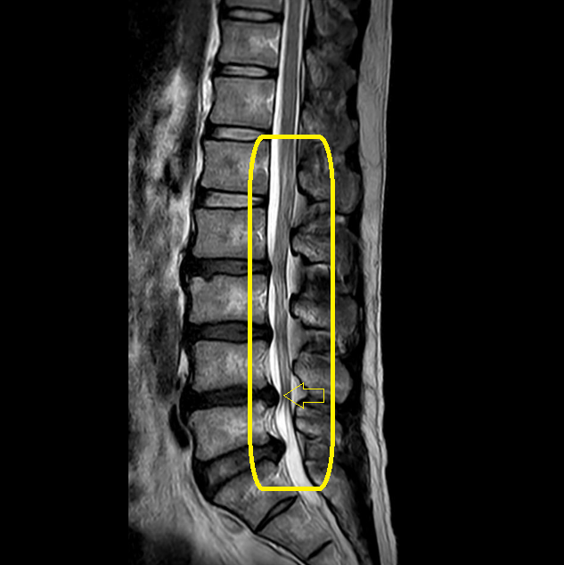 水津さんのMRI画像　側面