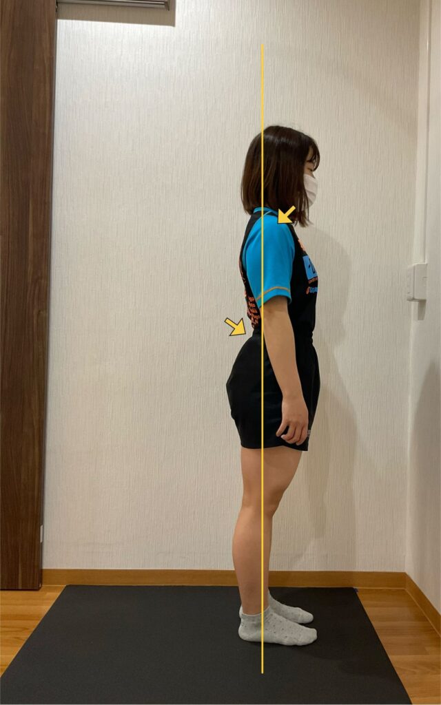 反り腰の姿勢 ビフォー