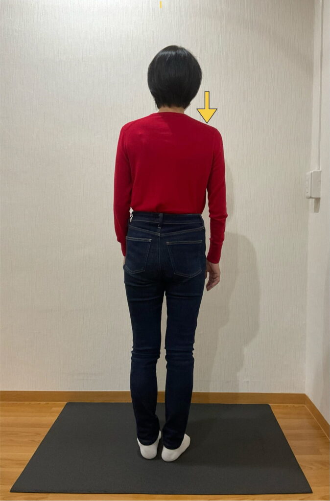 施術前の不良姿勢　前額面