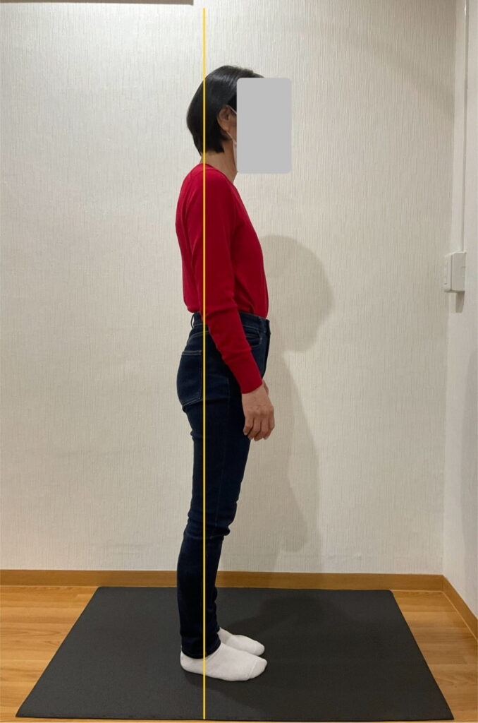 施術前の不良姿勢　矢状面