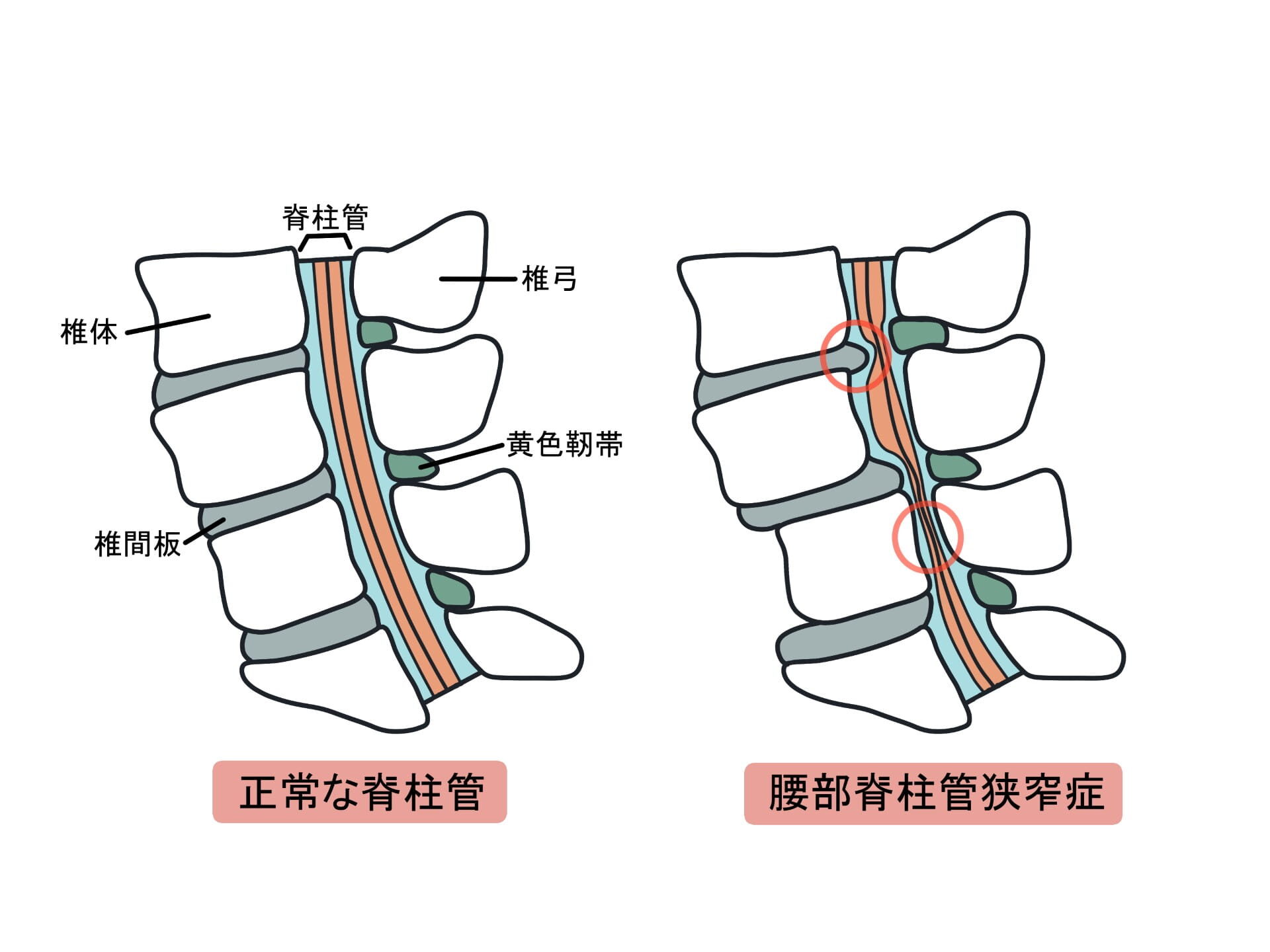 脊柱管狭窄症のイラスト