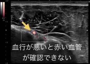 前上腕回旋動脈の拍動を確認